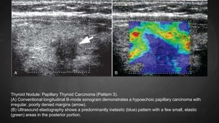 Thyroid Nodule: Papillary Thyroid Carcinoma (Pattern 3).
(A) Conventional longitudinal B-mode sonogram demonstrates a hypoechoic papillary carcinoma with
irregular, poorly denied margins (arrow).
(B) Ultrasound elastography shows a predominantly inelastic (blue) pattern with a few small, elastic
(green) areas in the posterior portion.
 