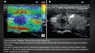 Thyroid Nodule: Papillary Thyroid Carcinoma (Pattern 4).
Right half of image shows a hypoechoic solid nodule (arrow) with microcalciications, typical of papillary
carcinoma.
Left half of image shows that on ultrasound elastography, the nodule is almost entirely inelastic (blue)
pattern 4. The small, elastic areas in the posterior portion of the lesion are artifacts caused by pulsations
of the underlying carotid artery.
 