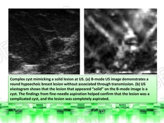 Ultrasound elastography of breast and prostate lesions | PPTX