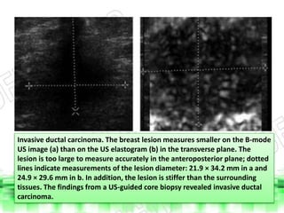 Ultrasound elastography of breast and prostate lesions | PPTX
