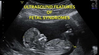 ULTRASOUND FEATURES
OF
FETAL SYNDROMES
 