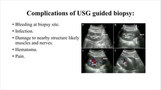 Ultrasound Guided Biopsy ppt . ANKITA KUMARIpdf | PDF