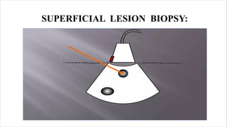 Ultrasound Guided Biopsy ppt . ANKITA KUMARIpdf | PDF