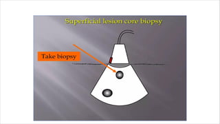 Ultrasound Guided Biopsy ppt . ANKITA KUMARIpdf | PDF