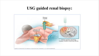 Ultrasound Guided Biopsy ppt . ANKITA KUMARIpdf | PDF