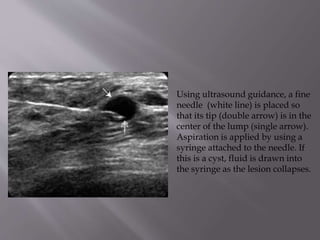 Using ultrasound guidance, a fine
needle (white line) is placed so
that its tip (double arrow) is in the
center of the lump (single arrow).
Aspiration is applied by using a
syringe attached to the needle. If
this is a cyst, fluid is drawn into
the syringe as the lesion collapses.

 