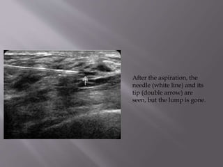 After the aspiration, the
needle (white line) and its
tip (double arrow) are
seen, but the lump is gone.

 