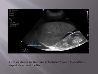 Here we clearly see free fluid in Morrison's pouch that extends
superiorly around the liver

 