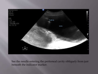 See the needle entering the peritoneal cavity obliquely from just
beneath the indicator marker.

 