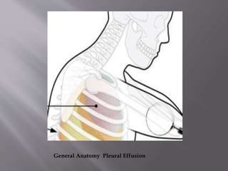 General Anatomy Pleural Effusion

 