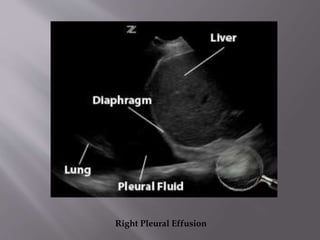 Right Pleural Effusion

 