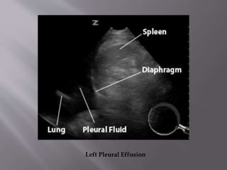 Left Pleural Effusion

 