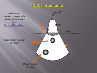Probe orientation
Reference
marker corresponds
to left side of screen
(see
Screen Orientation

Probe
Skin

Superficial “lesion”
to biopsy

Deep “lesion”
to biopsy

 
