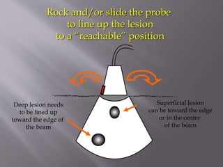 Rock and/or slide the probe
to line up the lesion
to a “reachable” position

Deep lesion needs
to be lined up
toward the edge of
the beam

Superficial lesion
can be toward the edge
or in the center
of the beam

 