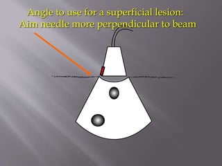 Angle to use for a superficial lesion:
Aim needle more perpendicular to beam

 