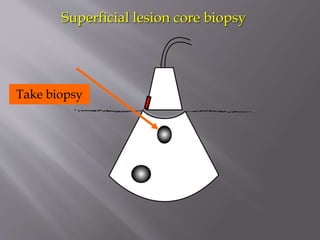 Superficial lesion core biopsy

Take biopsy

 