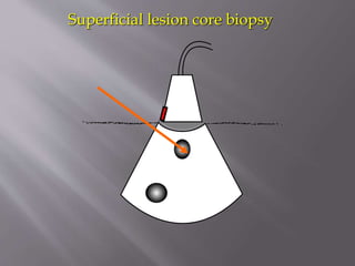 Superficial lesion core biopsy

 