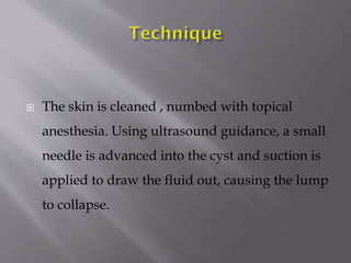 

The skin is cleaned , numbed with topical
anesthesia. Using ultrasound guidance, a small
needle is advanced into the cyst and suction is
applied to draw the fluid out, causing the lump
to collapse.

 