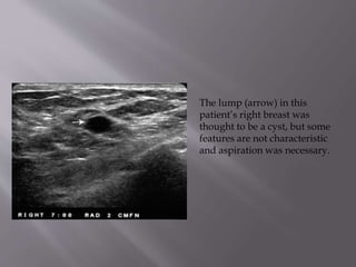 The lump (arrow) in this
patient’s right breast was
thought to be a cyst, but some
features are not characteristic
and aspiration was necessary.

 