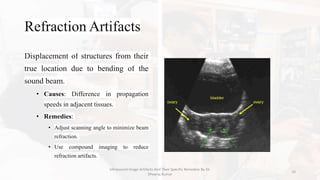 Ultrasound Image Artifacts and Their Remedies.pptx