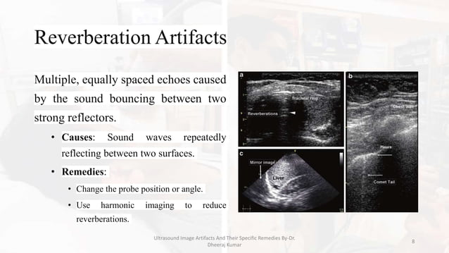 Ultrasound Image Artifacts and Their Remedies.pptx