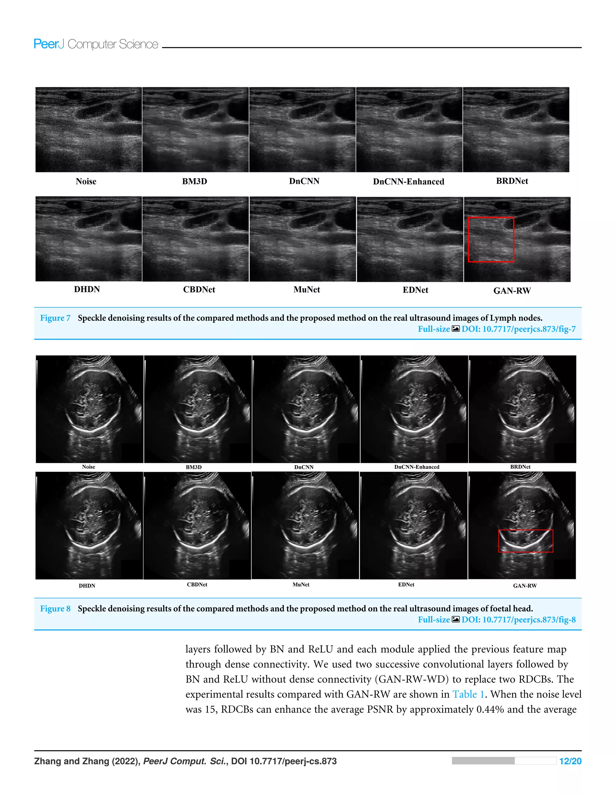 Figure 7 Speckle denoising results of the compared methods and the proposed method on the real ultrasound images of Lymph nodes.
Full-size DOI: 10.7717/peerjcs.873/fig-7
Figure 8 Speckle denoising results of the compared methods and the proposed method on the real ultrasound images of foetal head.
Full-size DOI: 10.7717/peerjcs.873/fig-8
layers followed by BN and ReLU and each module applied the previous feature map
through dense connectivity. We used two successive convolutional layers followed by
BN and ReLU without dense connectivity (GAN-RW-WD) to replace two RDCBs. The
experimental results compared with GAN-RW are shown in Table 1. When the noise level
was 15, RDCBs can enhance the average PSNR by approximately 0.44% and the average
Zhang and Zhang (2022), PeerJ Comput. Sci., DOI 10.7717/peerj-cs.873 12/20
 