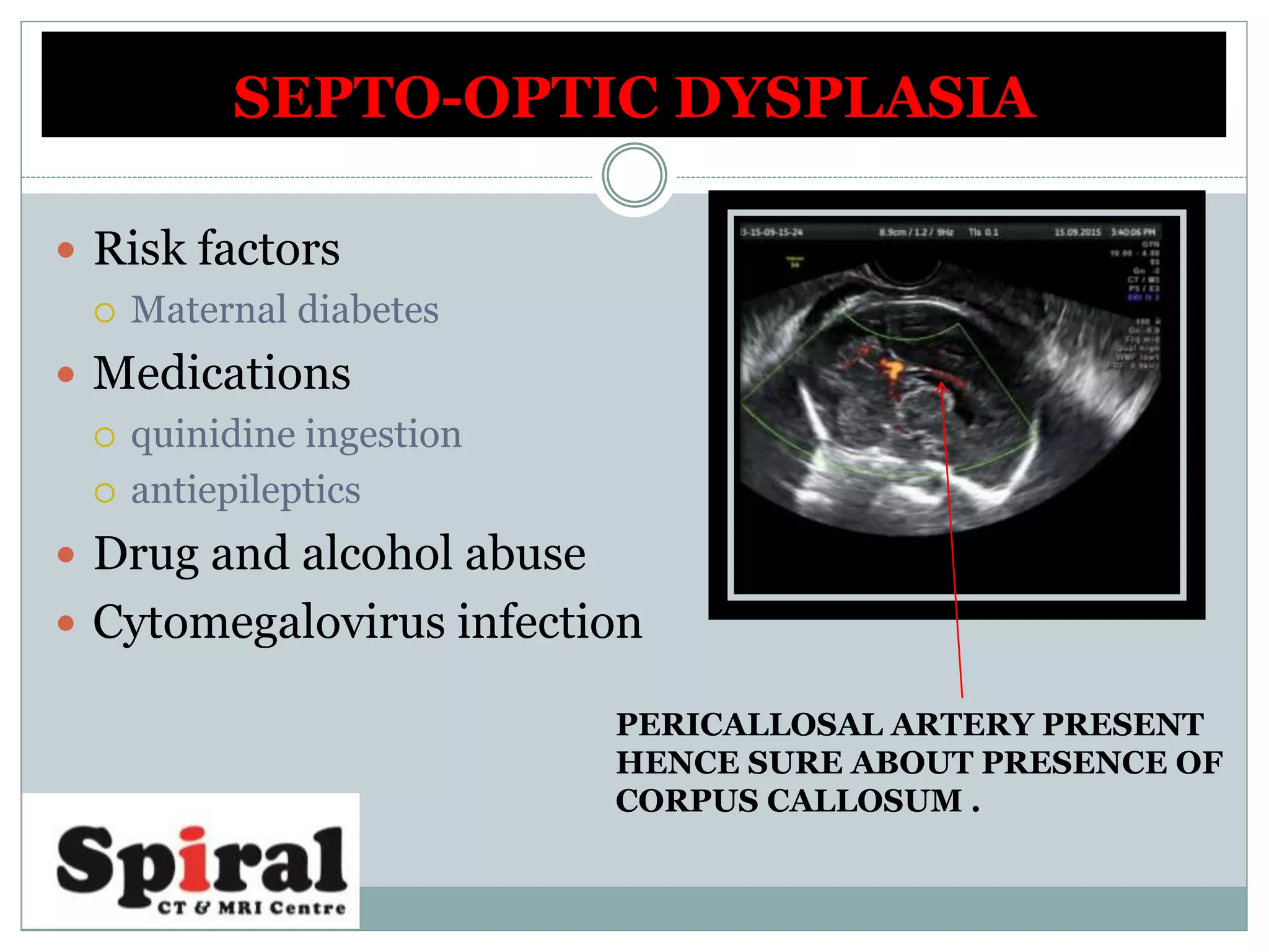  Risk factors
 Maternal diabetes
 Medications
 quinidine ingestion
 antiepileptics
 Drug and alcohol abuse
 Cytomegalovirus infection
SEPTO-OPTIC DYSPLASIA
PERICALLOSAL ARTERY PRESENT
HENCE SURE ABOUT PRESENCE OF
CORPUS CALLOSUM .
 