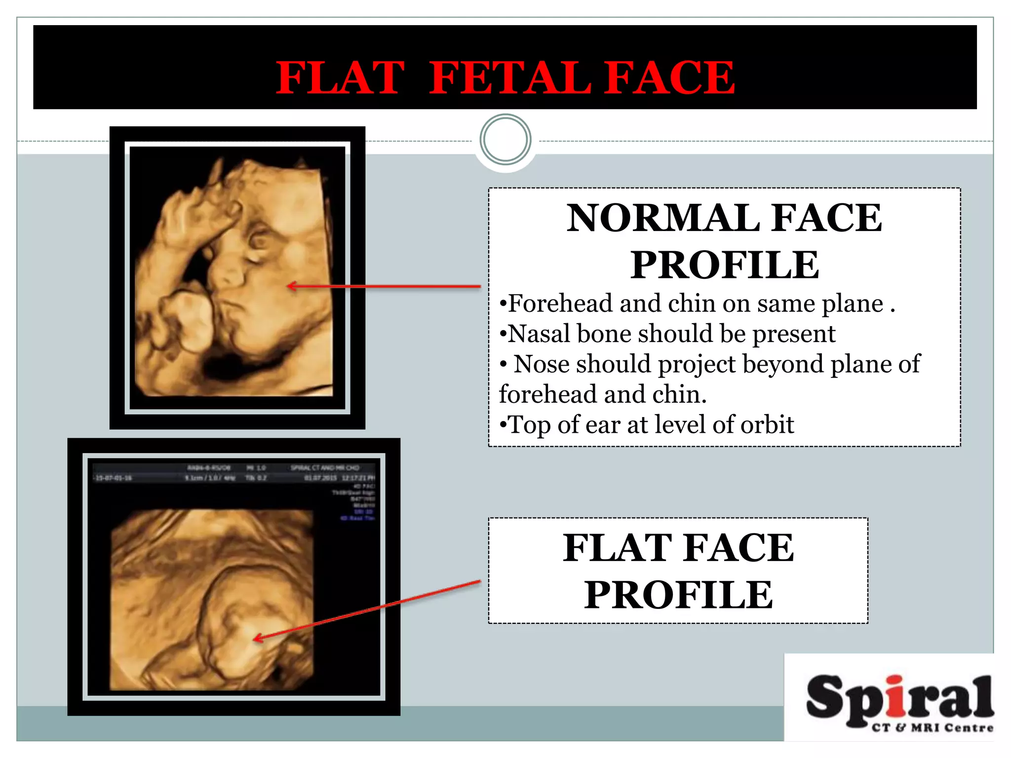 FLAT FETAL FACE
NORMAL FACE
PROFILE
•Forehead and chin on same plane .
•Nasal bone should be present
• Nose should project beyond plane of
forehead and chin.
•Top of ear at level of orbit
FLAT FACE
PROFILE
 