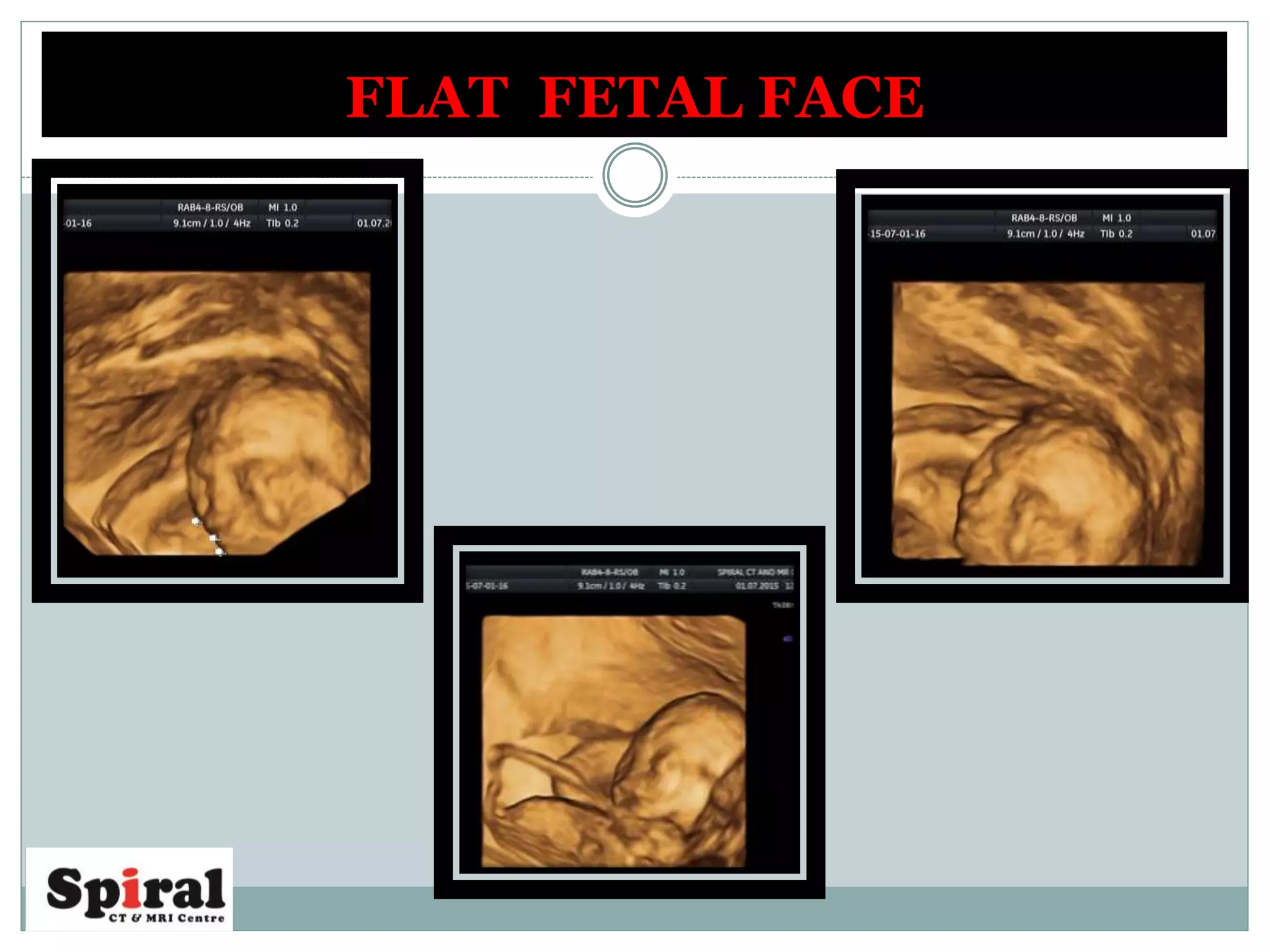 FLAT FETAL FACE
 