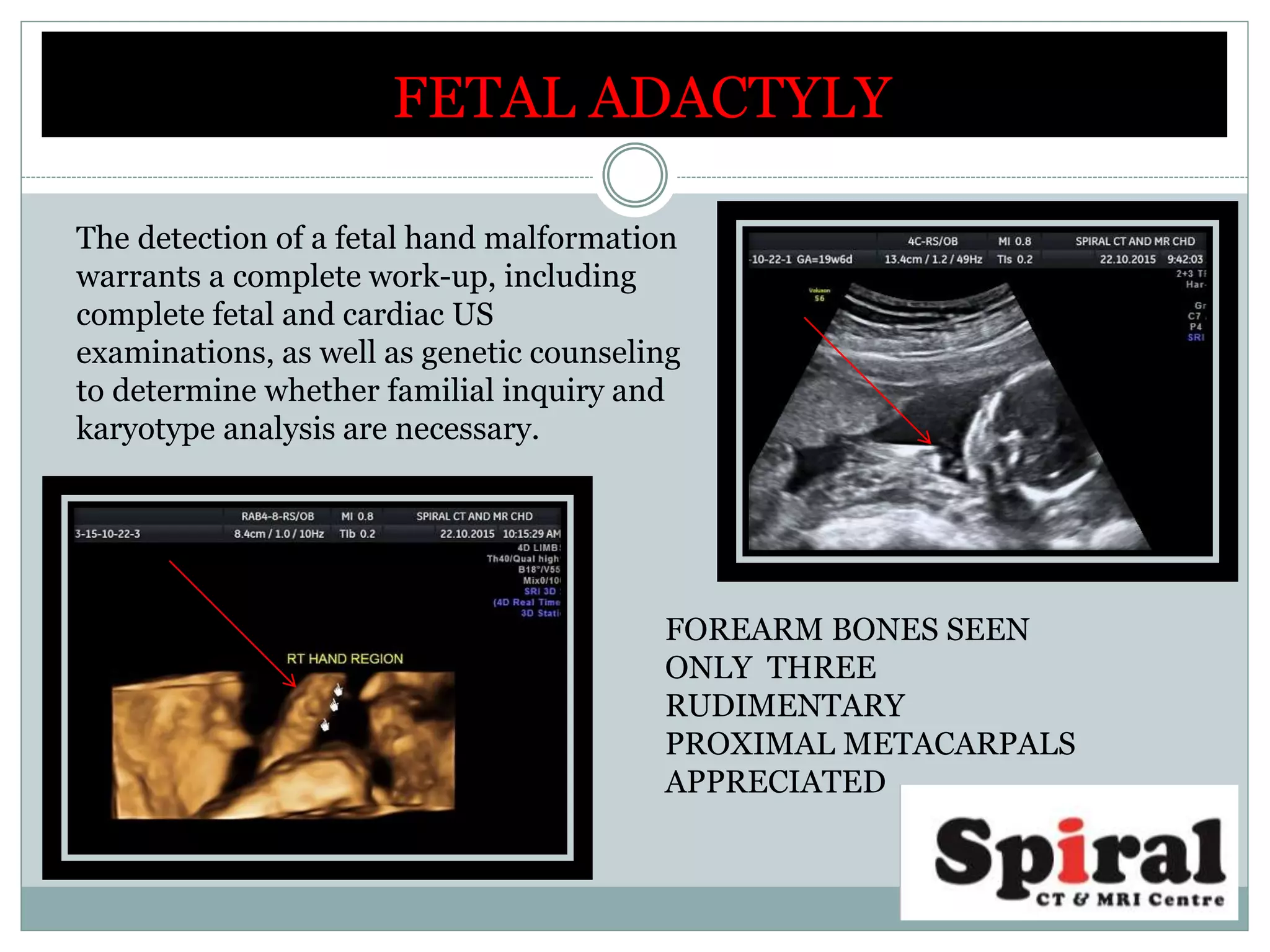 FETAL ADACTYLY
The detection of a fetal hand malformation
warrants a complete work-up, including
complete fetal and cardiac US
examinations, as well as genetic counseling
to determine whether familial inquiry and
karyotype analysis are necessary.
FOREARM BONES SEEN
ONLY THREE
RUDIMENTARY
PROXIMAL METACARPALS
APPRECIATED
 