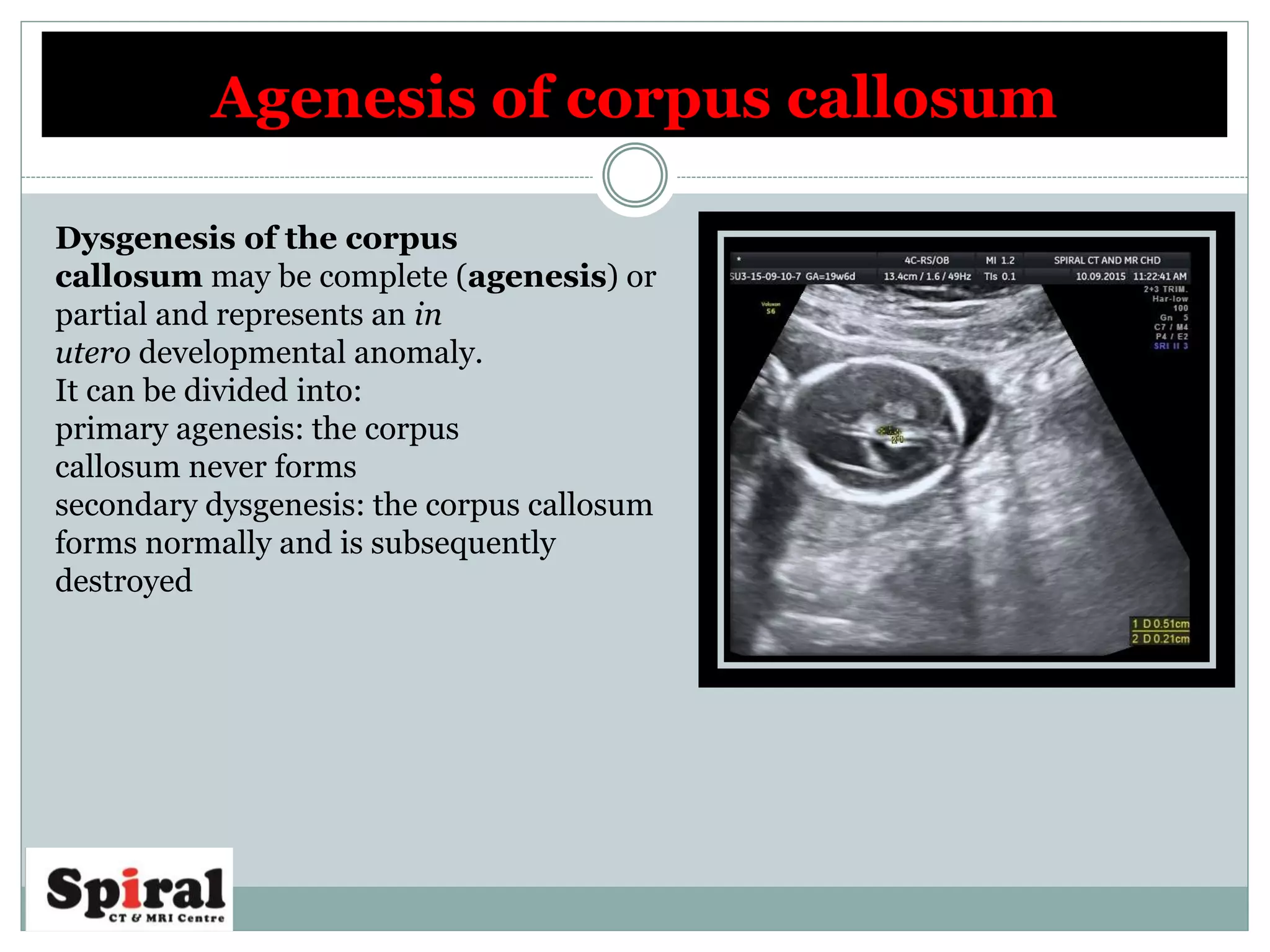 Agenesis of corpus callosum
Dysgenesis of the corpus
callosum may be complete (agenesis) or
partial and represents an in
utero developmental anomaly.
It can be divided into:
primary agenesis: the corpus
callosum never forms
secondary dysgenesis: the corpus callosum
forms normally and is subsequently
destroyed
 