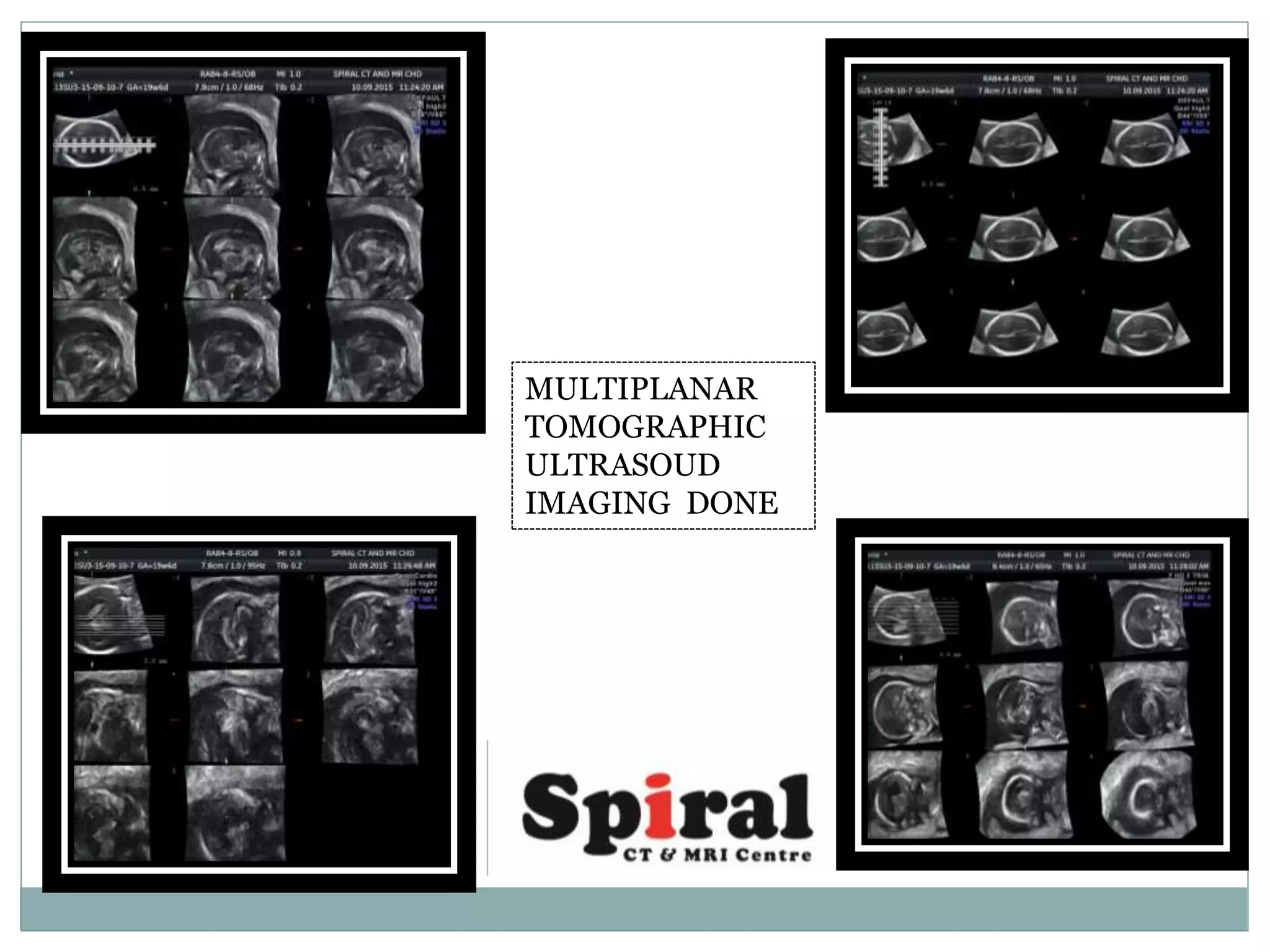 MULTIPLANAR
TOMOGRAPHIC
ULTRASOUD
IMAGING DONE
 