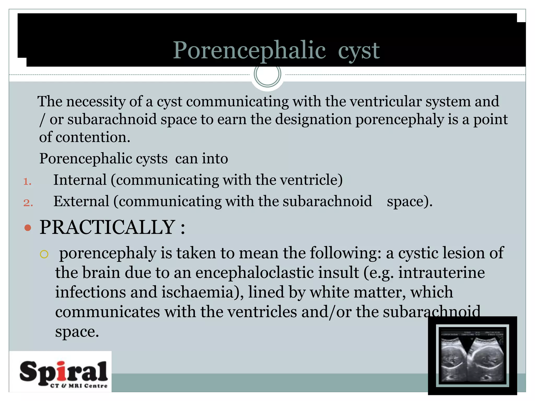 The necessity of a cyst communicating with the ventricular system and
/ or subarachnoid space to earn the designation porencephaly is a point
of contention.
Porencephalic cysts can into
1. Internal (communicating with the ventricle)
2. External (communicating with the subarachnoid space).
 PRACTICALLY :
 porencephaly is taken to mean the following: a cystic lesion of
the brain due to an encephaloclastic insult (e.g. intrauterine
infections and ischaemia), lined by white matter, which
communicates with the ventricles and/or the subarachnoid
space.
Porencephalic cystPorencephalic cyst
 