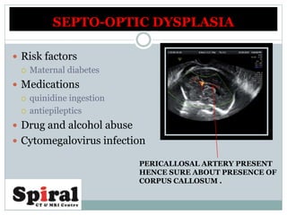  Risk factors
 Maternal diabetes
 Medications
 quinidine ingestion
 antiepileptics
 Drug and alcohol abuse
 Cytomegalovirus infection
SEPTO-OPTIC DYSPLASIA
PERICALLOSAL ARTERY PRESENT
HENCE SURE ABOUT PRESENCE OF
CORPUS CALLOSUM .
 