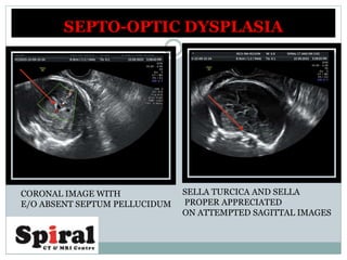 SEPTO-OPTIC DYSPLASIA
CORONAL IMAGE WITH
E/O ABSENT SEPTUM PELLUCIDUM
SELLA TURCICA AND SELLA
PROPER APPRECIATED
ON ATTEMPTED SAGITTAL IMAGES
 