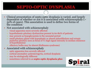  Clinical presentation of septo-optic dysplasia is varied, and largely
dependent of whether or not it is associated with schizencephaly (~
50% of cases). This association is used to define two forms of
the condition .
 Not associated with schizencephaly
 visual apparatus more severely affected
 hypothalamic-pituitary dysfunction present in 60-80% of patients
 may present as hypoglycaemia in the neonatal period
 small pituitary gland with hypoplastic or absent infundibulum and ectopic
posterior pituitary seen as focus of T1 high signal intensity in median eminence
of hypothalamus
 olfactory bulbs may be absent (Kallmann syndrome)
 Associated with schizencephaly
 optic apparatus less severely affected
 cortical anomalies: polymicrogyria, cortical dysplasia
 may be etiologically different
 sometimes referred to as septo-optic dysplasia plus
SEPTO-OPTIC DYSPLASIA
 