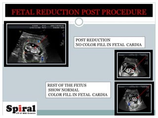 FETAL REDUCTION POST PROCEDURE
POST REDUCTION
NO COLOR FILL IN FETAL CARDIA
REST OF THE FETUS
SHOW NORMAL
COLOR FILL IN FETAL CARDIA
 