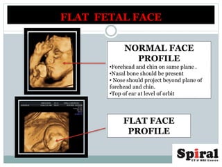 FLAT FETAL FACE
NORMAL FACE
PROFILE
•Forehead and chin on same plane .
•Nasal bone should be present
• Nose should project beyond plane of
forehead and chin.
•Top of ear at level of orbit
FLAT FACE
PROFILE
 