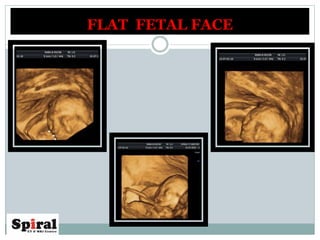 FLAT FETAL FACE
 