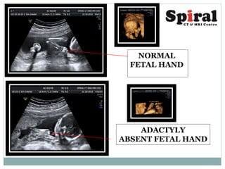 NORMAL
FETAL HAND
ADACTYLY
ABSENT FETAL HAND
 