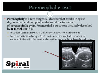 Porencephalic cyst
 Porencephaly is a rare congenital disorder that results in cystic
degeneration and encephalomalacia and the formation
of porencephalic cysts. Porencephalic cysts were originally described
by R Heschl in 1859
 Broadest definition being a cleft or cystic cavity within the brain .
 Narrow definition being a focal cystic area of encephalomalacia that
communicates with the ventricular system and/or the subarachnoid space.
 