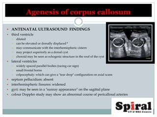  ANTENATAL ULTRASOUND FINDINGS
 third ventricle
 dilated
 can be elevated or dorsally displaced 8
 may communicate with the interhemispheric cistern
 may project superiorly as a dorsal cyst
 choroid may be seen as echogenic structure in the roof of the cyst
 lateral ventricles
 widely spaced parallel bodies (racing car sign)
 small frontal horns
 colpocephaly: which can give a "tear drop" configuration on axial scans
 septum pellucidum: absent
 interhemispheric fissures: widened
 gyri: may be seen in a "sunray appearance" on the sagittal plane
 colour Doppler study may show an abnormal course of pericallosal arteries
Agenesis of corpus callosum
 
