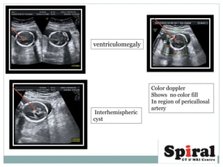 ventriculomegaly
Interhemispheric
cyst
Color doppler
Shows no color fill
In region of pericallosal
artery
 