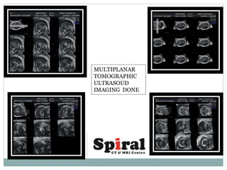 MULTIPLANAR
TOMOGRAPHIC
ULTRASOUD
IMAGING DONE
 