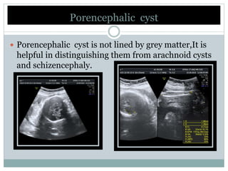  Porencephalic cyst is not lined by grey matter,It is
helpful in distinguishing them from arachnoid cysts
and schizencephaly.
Porencephalic cyst
 