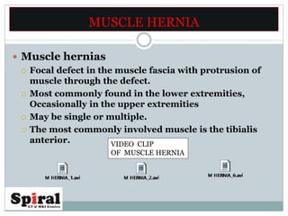 MUSCLE HERNIA
 Muscle hernias
 Focal defect in the muscle fascia with protrusion of
muscle through the defect.
 Most commonly found in the lower extremities,
Occasionally in the upper extremities
 May be single or multiple.
 The most commonly involved muscle is the tibialis
anterior. VIDEO CLIP
OF MUSCLE HERNIA
 