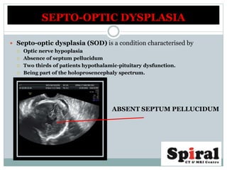 SEPTO-OPTIC DYSPLASIA
 Septo-optic dysplasia (SOD) is a condition characterised by
 Optic nerve hypoplasia
 Absence of septum pellucidum
 Two thirds of patients hypothalamic-pituitary dysfunction.
 Being part of the holoprosencephaly spectrum.
ABSENT SEPTUM PELLUCIDUM
 