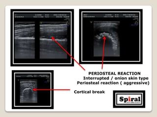 Cortical break
PERIOSTEAL REACTION
Interrupted / onion skin type
Periosteal reaction ( aggressive)
 