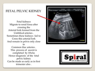 FETAL PELVIC KIDNEY
Fetal kidneys
Migrate to renal fossa after
crossing the
Arterial fork formed from the
Umbilical arteries .
Sometimes these kidneys fail to
Cross this arterial fork
And remain in pelvis only close
to
Common iliac arteries .
This process of ascent is
completed by 10wks
Hence diagnosis of the fetal
pelvic kidney
Can be made as early as in first
trimester also .
 