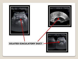 DILATED EJACULATORY DUCT
 